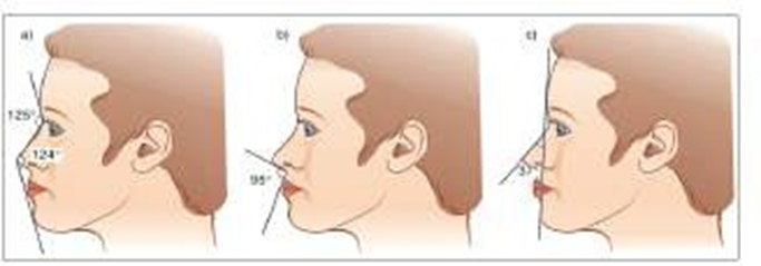 Gambar 7. Sudut penting untuk proporsionalitas wajah dengan nilai normal: sudut naso-frontal dan naso-mental (a), sudut naso-labial (b), sudut naso-fasial (c)
