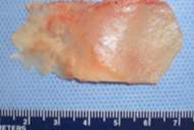 Figure 8 Septal Cartilage