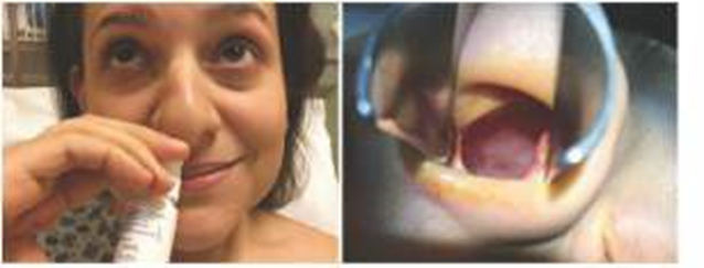 Picture 11. Use Xylometazoline (A), appearance mucosa The septum shows decreased vascularization of the septal mucosa (B). 19