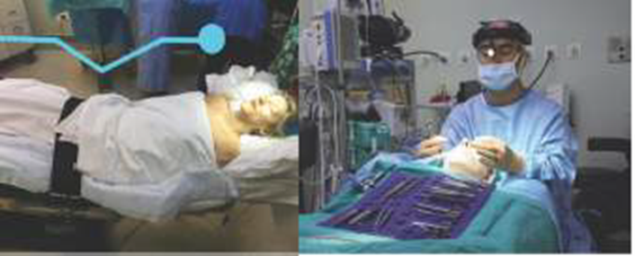 Picture 12. Patient positioned in position Trendelenburg backwards, with the head extended 20–30° (A) and the operator on the upper side of the patient (B). 19