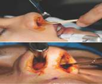 Picture 13. Applying povidone iodine (A), cut hair nose with knife surgery (B). 