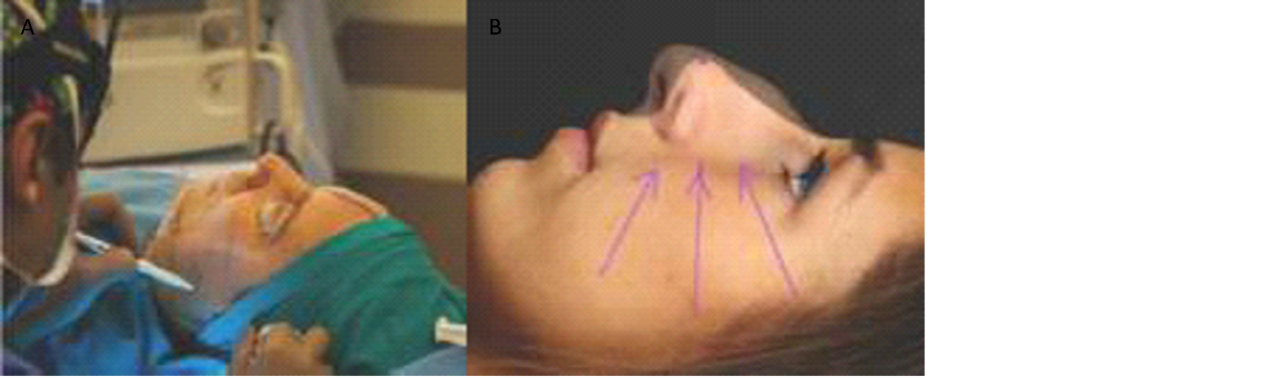 Figure 17. Depiction of markings on the patient. In the shaded photo, find the end (A), Mark end Which plan on nose patient. Draw a picture three line Which show point This (B). 20