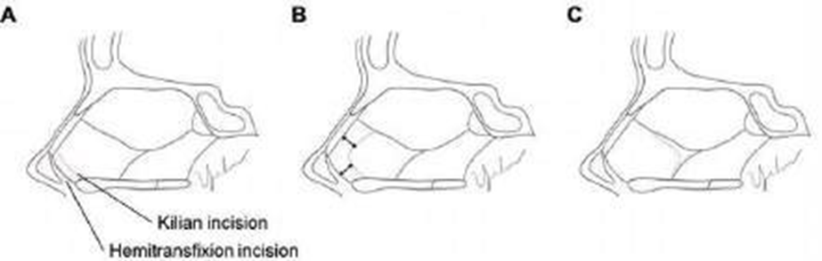 &nbsp;Incisions in septoplasty