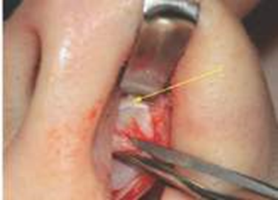 Picture 20. Incision on caudal septum