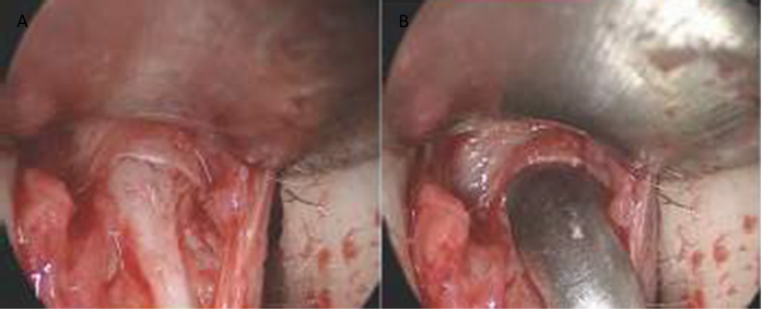 Figure 21. Endoscopic photograph showing the entry of the subperichondrial plane from the anterior septal angle. Using sharp-tipped scissors the posterior strut is completely separated from the septal angle (A). After the cartilages are separated by 3-4 mm, the going to back nose from corner septum done until cartilage upper lateral (B). 19