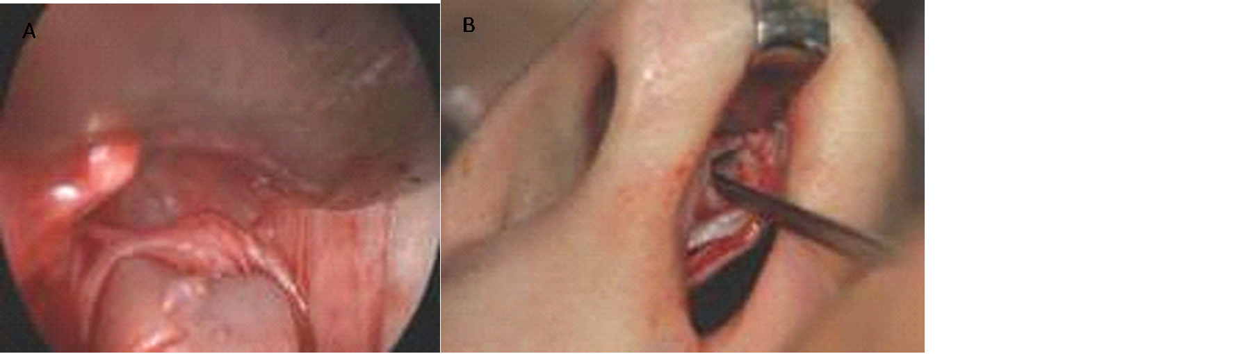 Picture 22. A) Moving elevator to side, dissection perichondrium upper lateral cartilage and stops at the ligament. B) continue with dissection of the nasal tip cartilage. 20