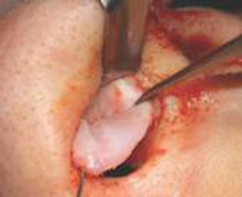 Picture 24 . Dissection tip And dorsum. 19