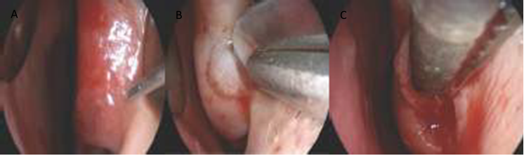 Fig. 25 Steps of turbenectomy with submucosal resection, a small amount of local anesthetic solution with epinephrine on the enlarged concha and wait a few minute (A),. use knife surgery, for incision shaped C measuring 4 mm on the anterior turbinate (B), Cut the cavernous tissue between the mucosa and bone (C). 20