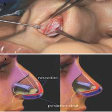 Picture. 27. Resection on septoplasty, septoplasty extracorporeal (A), illustration of septal resection (B)