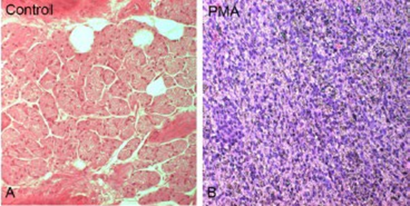 Comparison&nbsp;difference&nbsp;structural&nbsp;between&nbsp;control&nbsp;with&nbsp;pleomorphic adenoma of the parotid gland stained with&nbsp;HE. Parotid control network