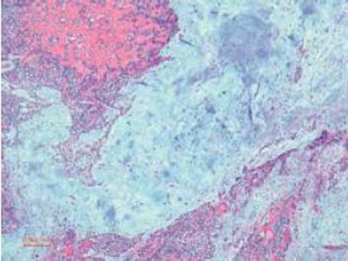 Adenoma&nbsp;pleomorphic&nbsp;looks a lot matrix&nbsp;myxochondroid&nbsp;And&nbsp;cell&nbsp;myoepithelial&nbsp;(50×&nbsp;coloring&nbsp;H&E)