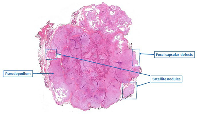 adenoma&nbsp;pleomorphic&nbsp;parotid&nbsp;all in all&nbsp;with&nbsp;typical capsule characteristics 