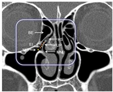 Figure 6. Components of the Osteomeatal Complex on Coronal CT. MO: maxillary sinus ostium; EI: infundibulum ethmoid; BE: bull ethmoidalis; MM: meatus medium; UP: uncinate process; HS: hiatus semilunaris 10