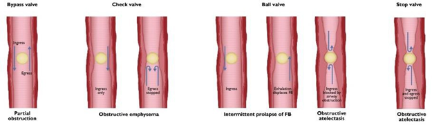 Picture 2.2 Type obstruction consequence object foreign. (A) Obstruction partial. Air can get out And enter, only cause wheezing. (B) Obstruction One direction. Air can enter However No can go out, cause emphysema lungs. (C) Obstruction total. Air cannot enter or exit, causing pulmonary atelectasis. 2