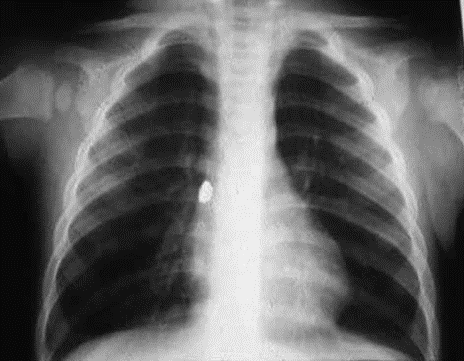 Picture 2.3 Description Photo plain chest aspiration object foreign (buffer earring) lodged in the first branch of the right bronchus