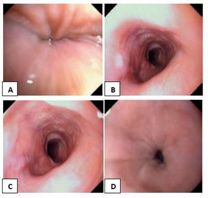 Picture 2. A Sphincter esophagus part on. B. Narrowing in aortic arch crossing. C. Narrowing of the left bronchus compression. D. Lower esophageal sphincter. 1,2,5