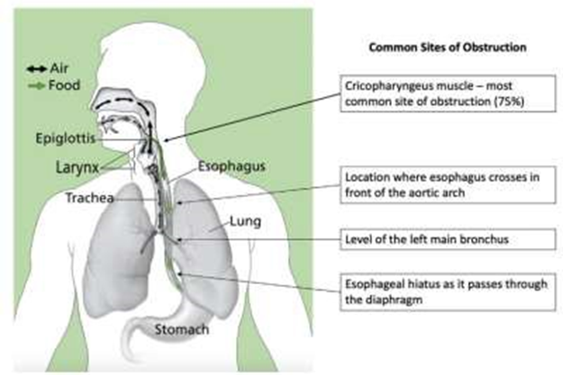 Figure 3. Most common locations of esophageal obstruction/impaction