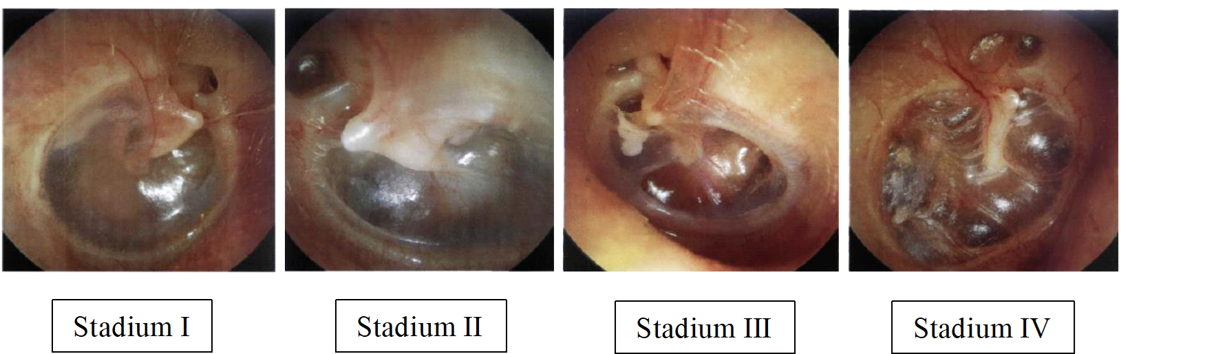 Picture 2.5. Classification atelectasis 14