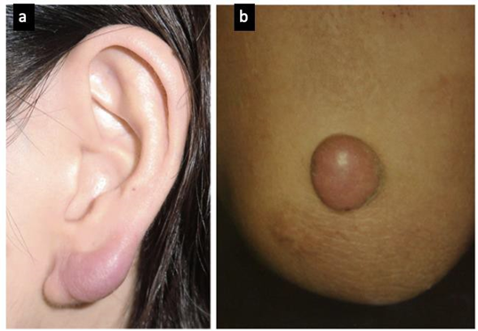 Picture 8. Tumor Benign Which Similar Keloid. a) Pseudolymphoma And b) Xanthogranuloma. 20
