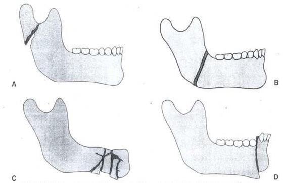 Picture 10. Type fracture mandible. A. Greenstick ; B. Simple ; C. Commuter ; D. Compound 3