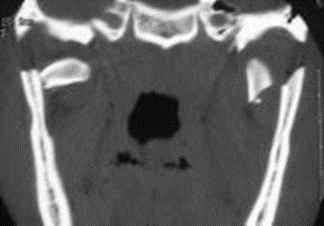 Picture 11. CT Scan coronal fracture bilateral condyles . 8