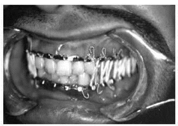 Picture 13 . Fixation maxillomandibular. 9