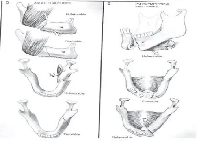 Picture 15 . Favorable fracture and unfavorable. 12