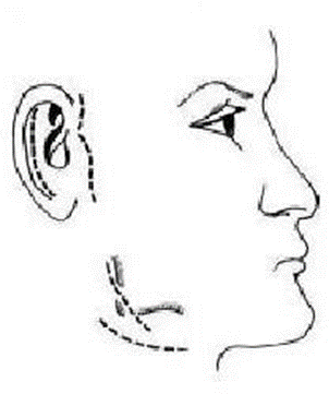 Picture 16. Extraoral approach 