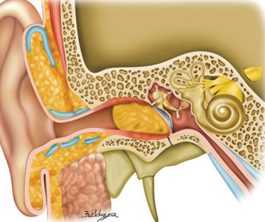  Gambar2. Keratosis obturans pada MAE1