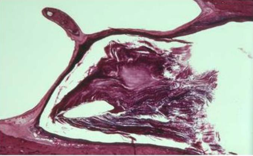 Figure 3. Horizontal section shows the inner MAE which closed by keratin squamous Which congested (hematoxylin eosin, 30x). 15,21
