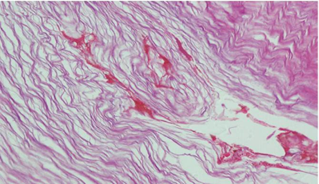 Picture 4. Fragment keratin laminar acellular (hematoxylin-eosin, 400x) 13