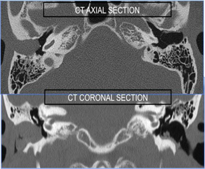 Picture 6. CT scan from keratosis obturans 15