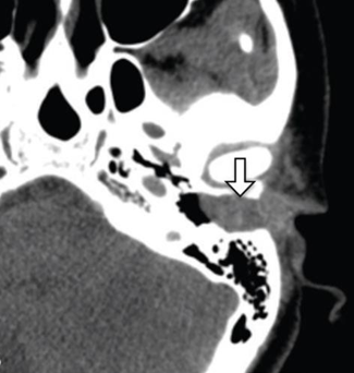 Figure 7. Axial CT scan of the soft tissue window. show existence mass network soft (arrow) occupy MAE, bulging membrane timpani, without erosion bone, local dilatation in lesion 18