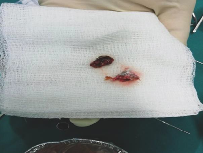 Picture 8. Clot keratin Which thick mixed with earwax which was taken from MAE after the 13th operation process