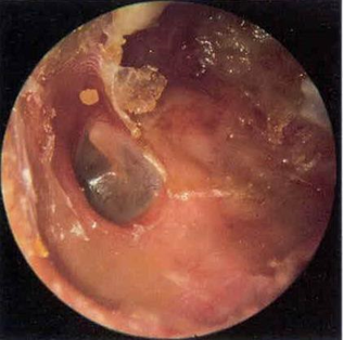 Figure 9. Secondary automatoidectomy due to keratosis obturans 15 In addition That, there is A case Which report the occurrence paralysis