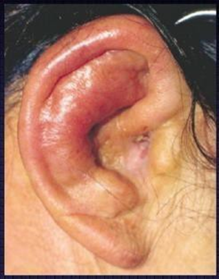 Picture 3. Perichondritis auricle. 20