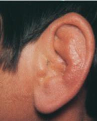 Picture 3. Perichondritis auricle. 20