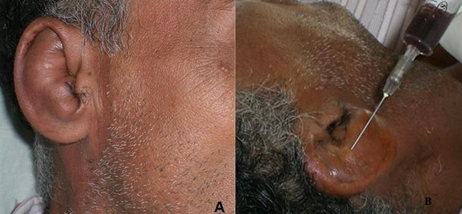 Picture 4 . Appearance Clinical Auricular Hematoma Dextra 28