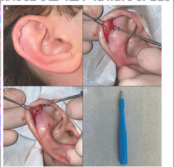 Picture 8. Incision Procedure Auricular Hematoma 37