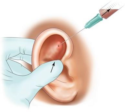 Picture 9 . Technique Aspiration Needle For evacuation hematoma 2 Tampons Post Hematoma Evacuation