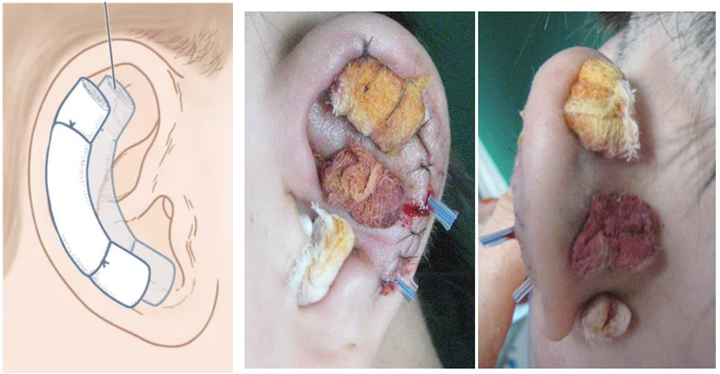 Picture 10 . Use Tampon post evacuation hematoma. 36