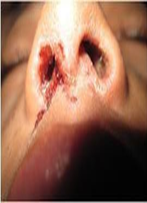Picture 2.5 Vestibulitis