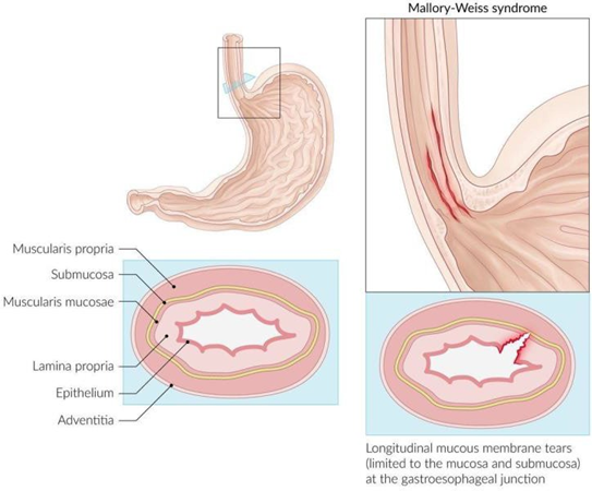 Picture 1. Anatomy Esophagus Normal compared to with SMW. 3.4