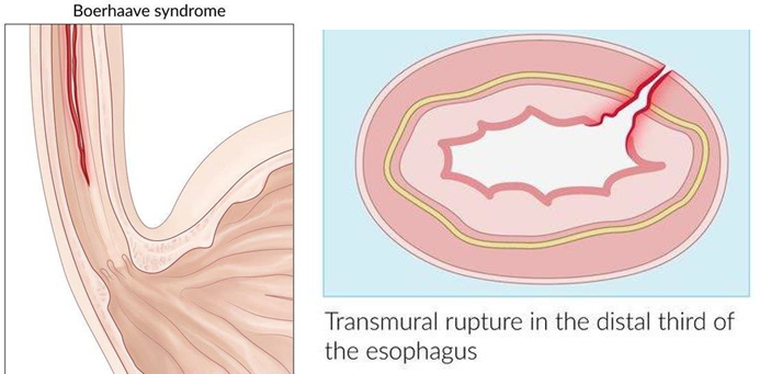 Picture 2. Anatomy Esophagus on syndrome Boerhaave.3.4