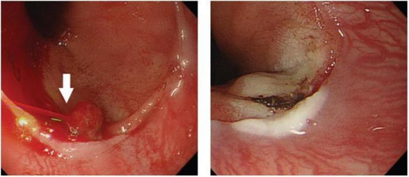 Picture 4. Endoscopic Findings Before And After Hemostasis. 7