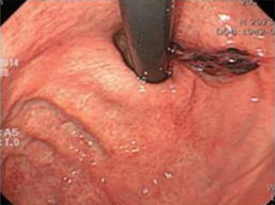 Picture 7. Therapy Endoscopic Injection . 7