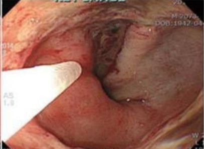 Picture 7. Therapy Endoscopic Injection . 7