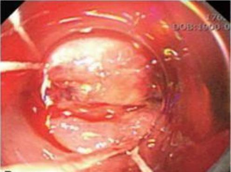 Picture 9. Endoscopic Band Ligation . 7