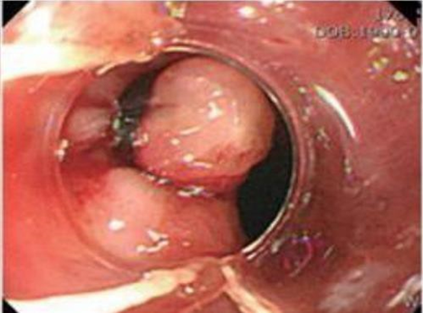 Picture 9. Endoscopic Band Ligation . 7