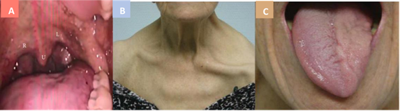 Figure 2 Collet-Sicard syndrome: (A) Elevation disturbance on the right side of the soft palate. compared to with side left with refers to uvula (U) (CNX palsy right). (B) paralysis nerve cranial XI left which result in drooping on shoulder and clavicular prominence; (C) left cranial nerve XII paralysis causing atrophy on the left side tongue 13